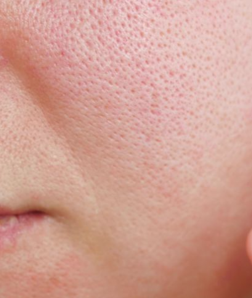 All About Large Pores