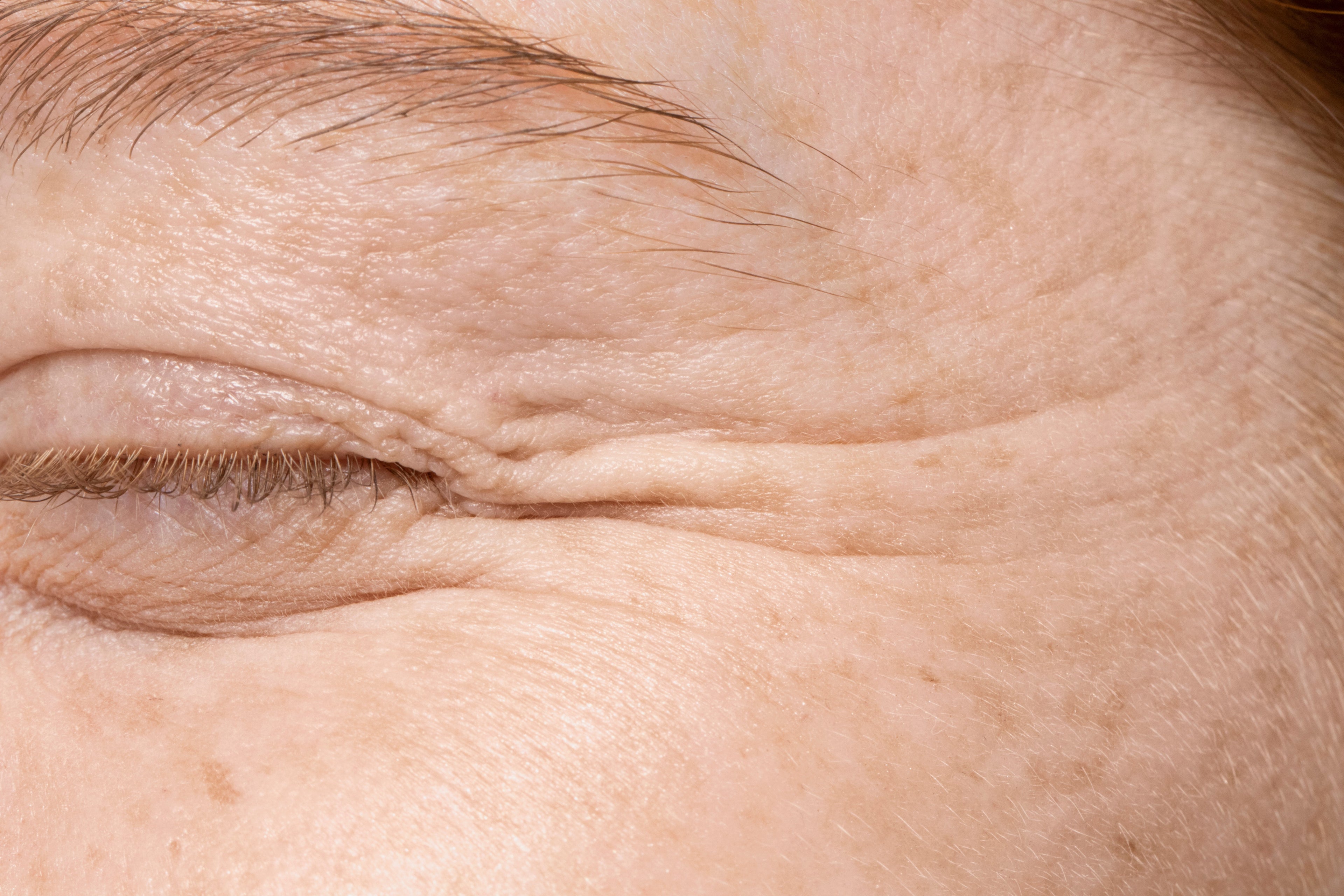 Do Microneedle Patches Actually Work for Wrinkles?
